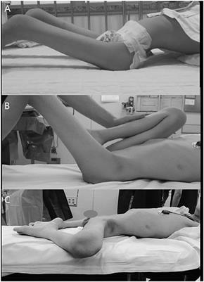 Hip-Spine Syndrome in Patients With Spinal Cord Injuries: Hyperlordosis Associated With Severe Hip Flexion Contracture